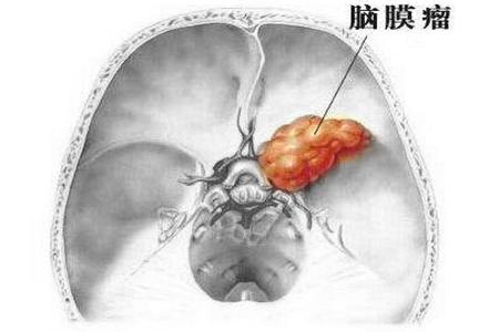 脑膜瘤术后怎么防止复发,脑膜瘤术后复发有哪些症状