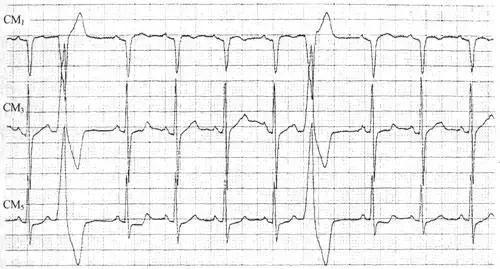 体检出早搏,体检报告疑似室性早搏影响投保吗