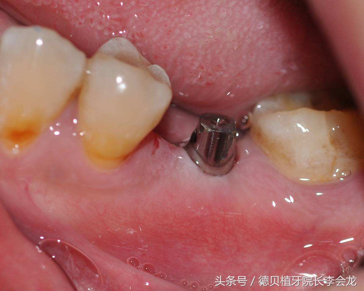 镶牙没镶好能卸掉重镶吗,镶牙只镶一个