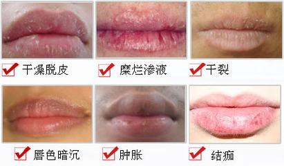 慢性唇炎吃点什么能缓解,慢性唇炎常见问题及注意事项