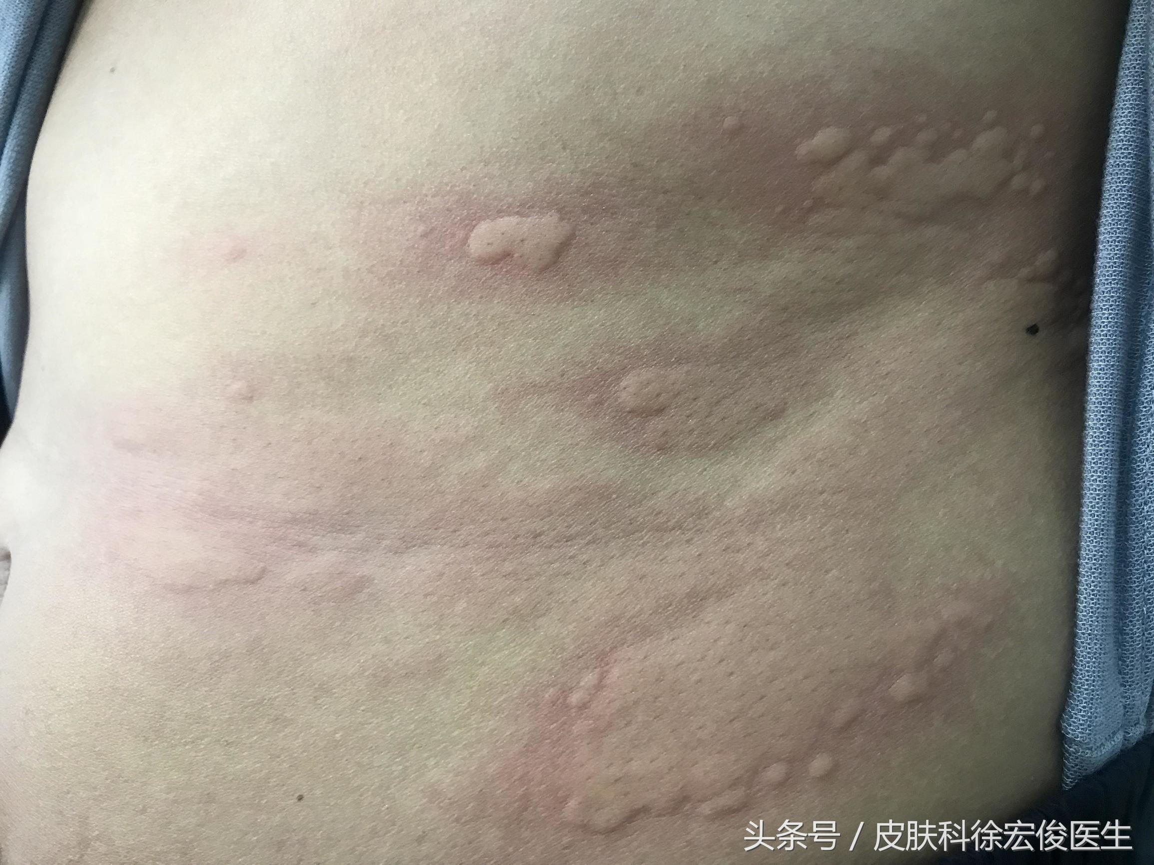 关于皮肤问题服用的激素药有哪些,激素皮肤病能根治吗