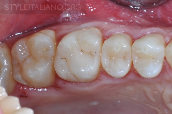 后牙修补贴片,后牙全瓷修复图片