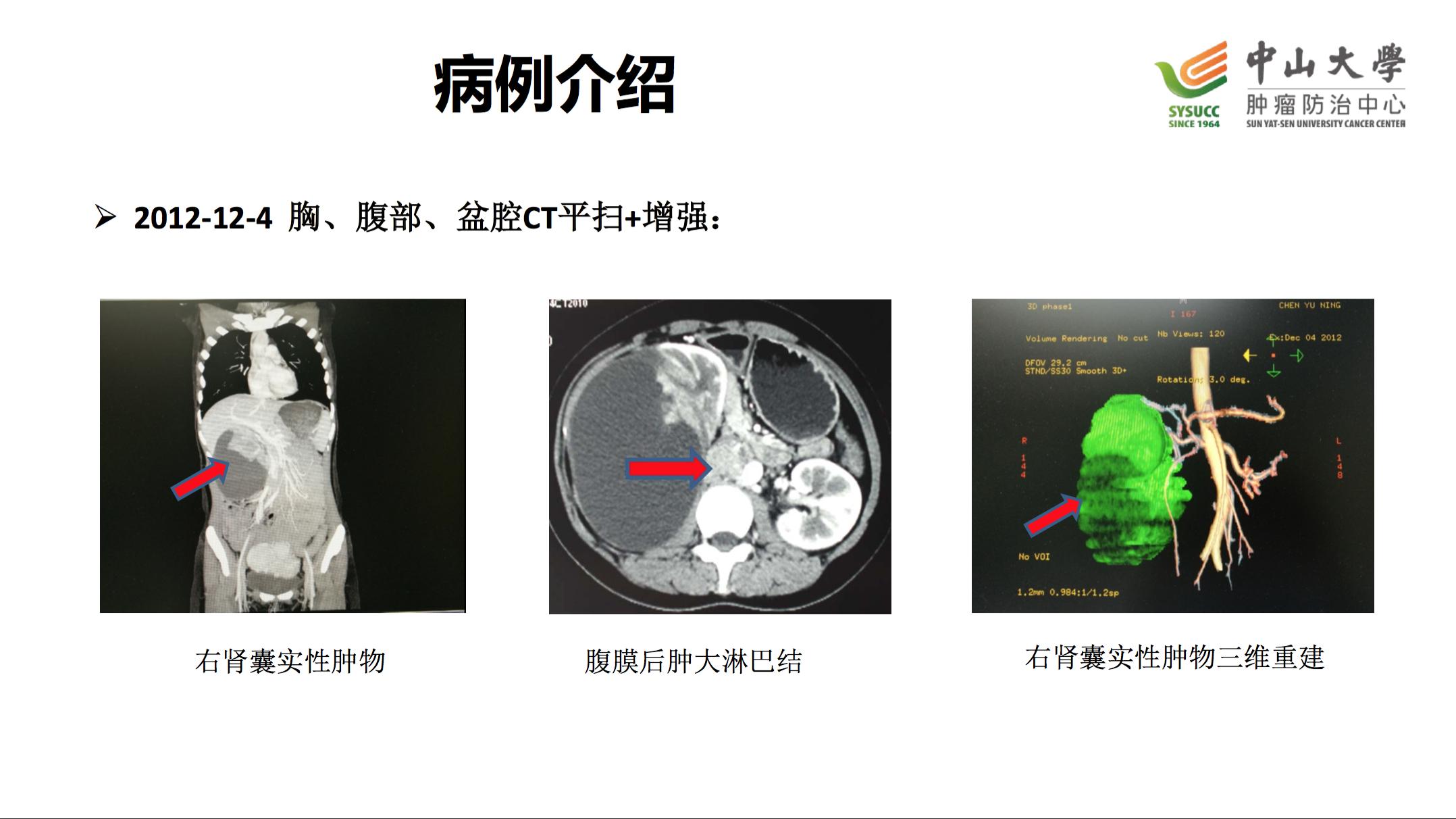 阿昔替尼联合单抗效果好吗,阿昔替尼联合免疫治疗肾癌