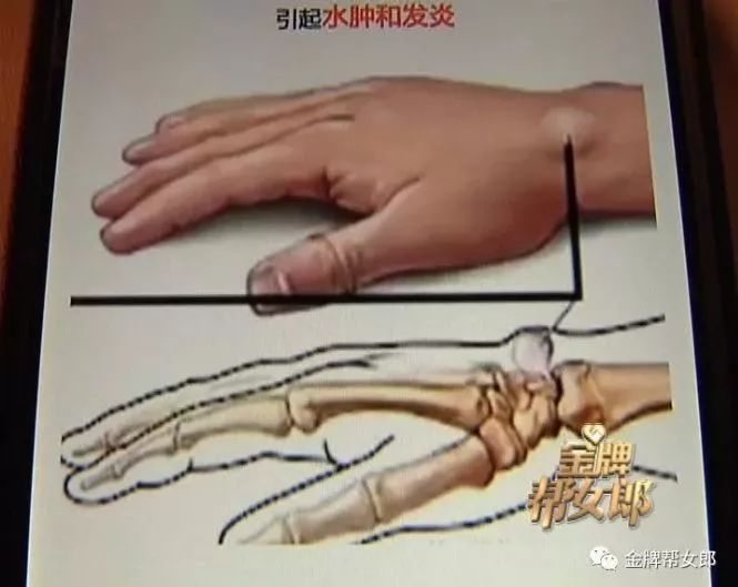 「可怕」一男子玩手机导致手指出现活动障碍！严重可致终生障碍！