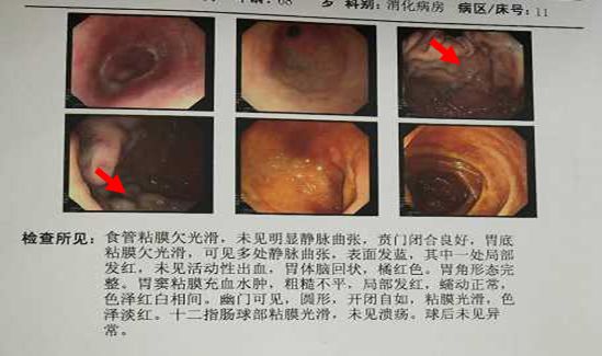 出血原因千千万,此例患者为哪般?