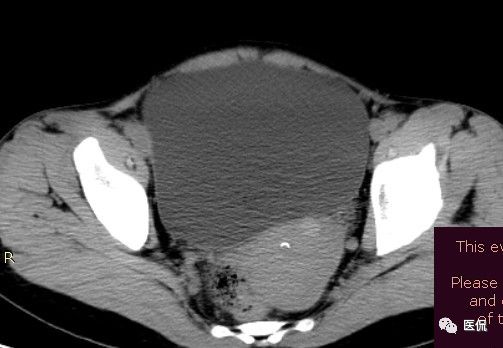 手术纱布遗留在体内可以吸收吗,手术纱布忘了取出会怎样