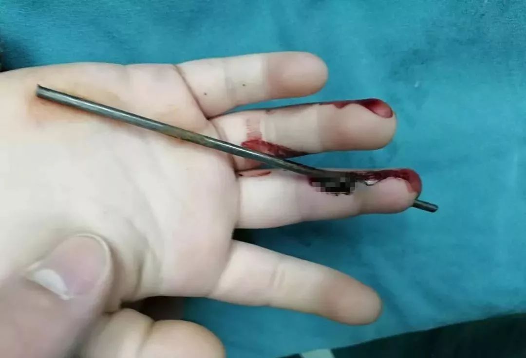 疼！家长们注意：熊孩子这样玩，钢丝刺穿右手中指！