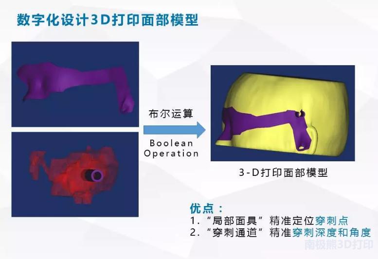 医学3d动画演示脑出血手术,3d演示脑出血治疗过程