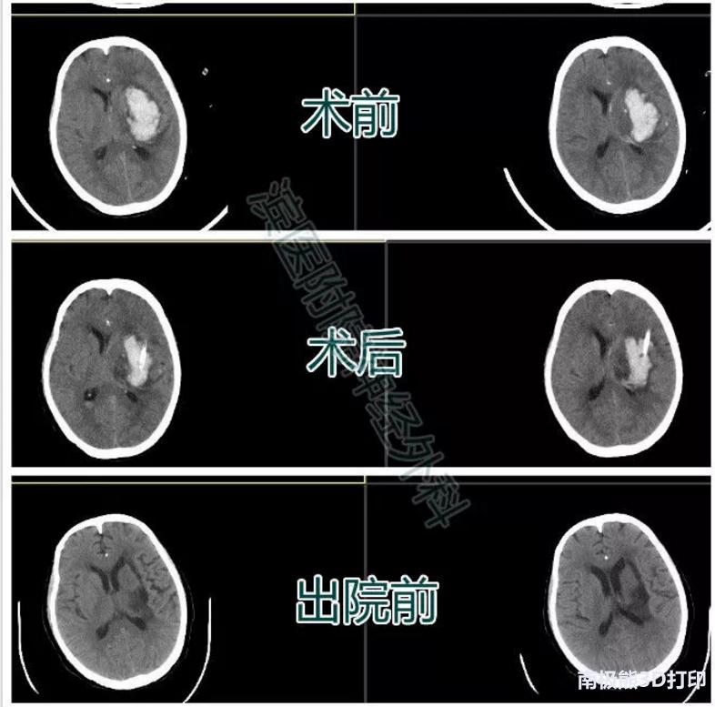 医学3d动画演示脑出血手术,3d演示脑出血治疗过程
