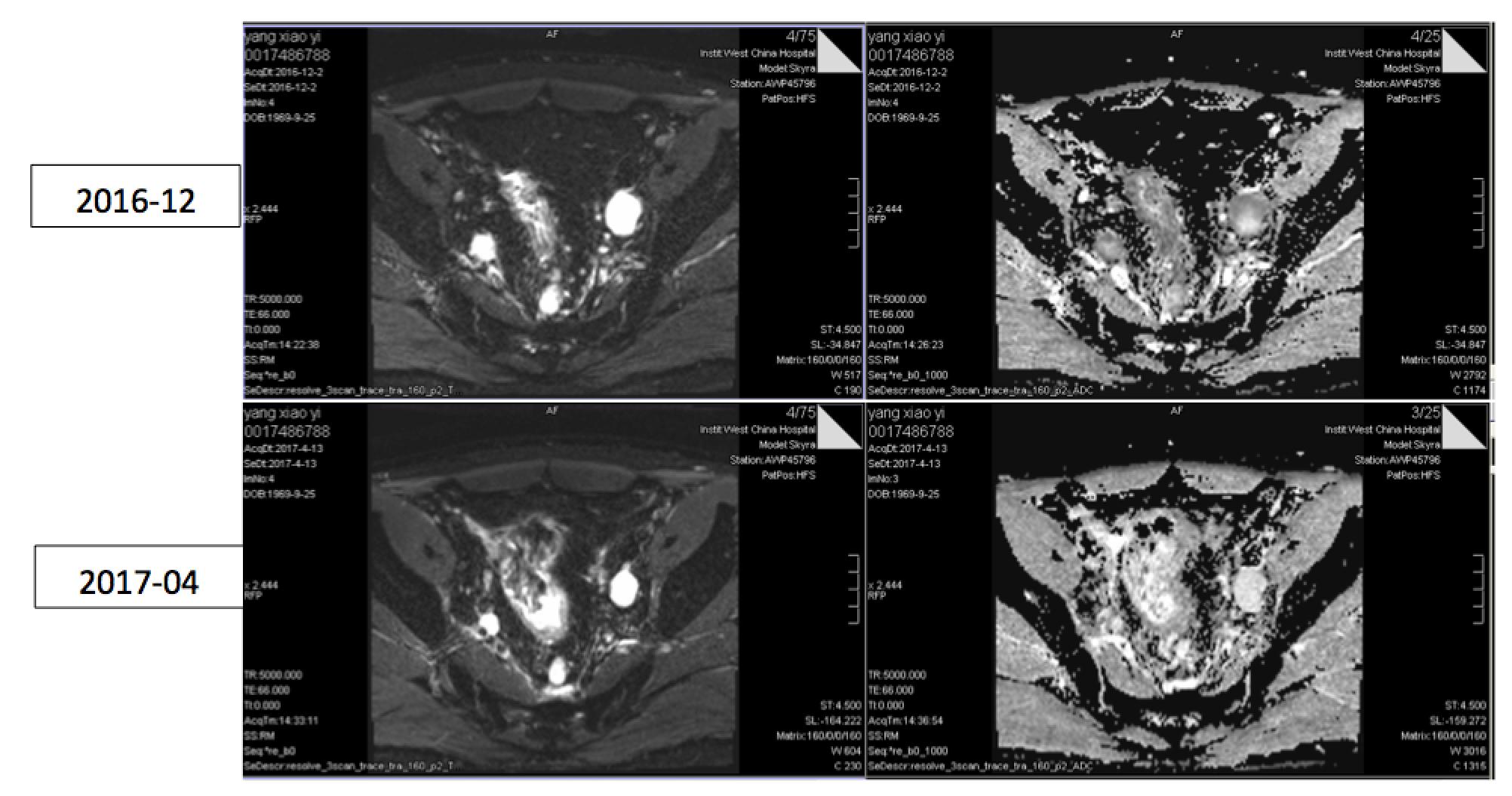 直肠腺癌肺转移最好的治疗方案,得了直肠腺癌不治疗能活几年