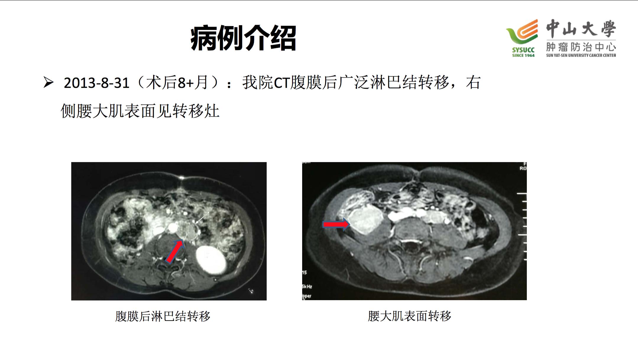 阿昔替尼联合单抗效果好吗,阿昔替尼联合免疫治疗肾癌