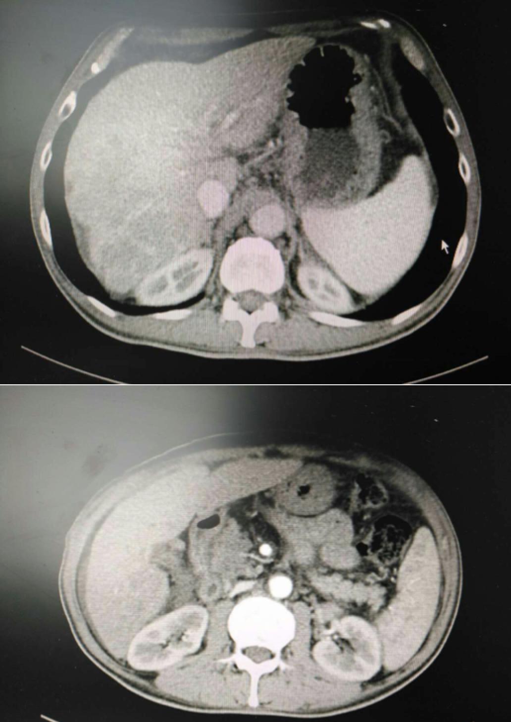 周仲国评价肝癌病例,周仲国分享肝癌早期复发