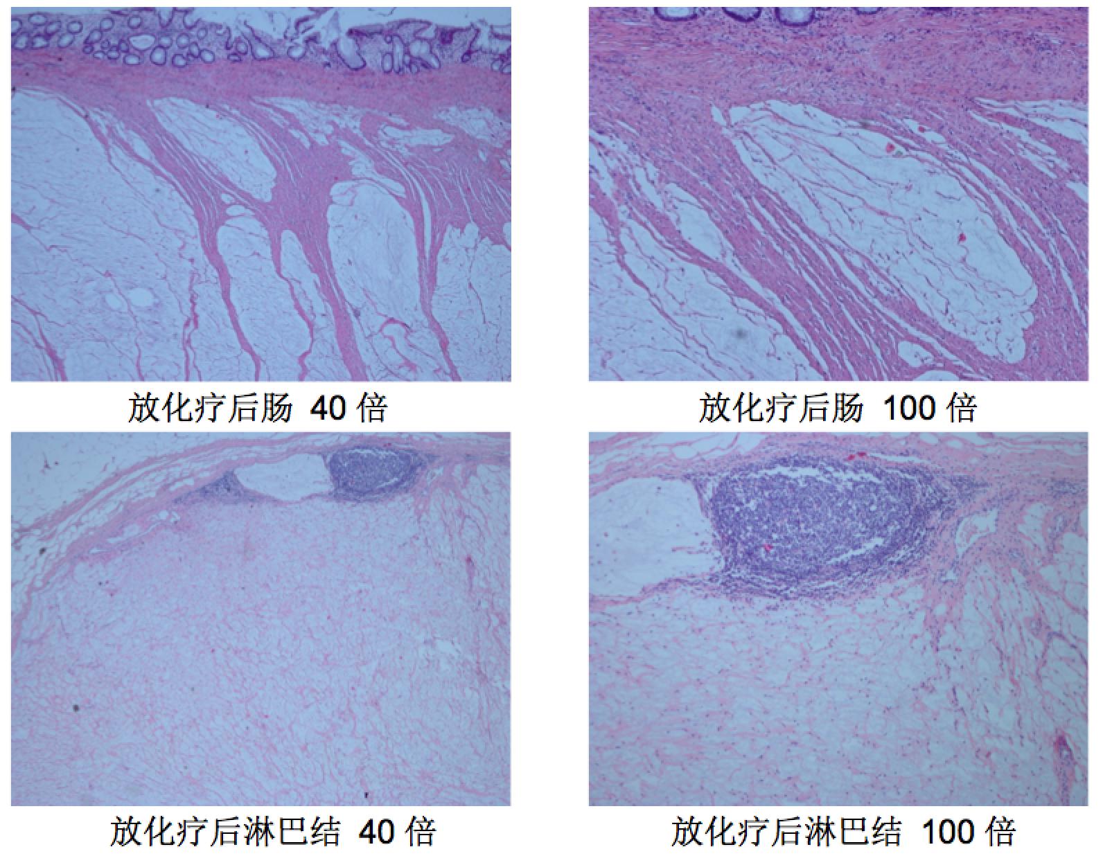 直肠腺癌肺转移最好的治疗方案,得了直肠腺癌不治疗能活几年