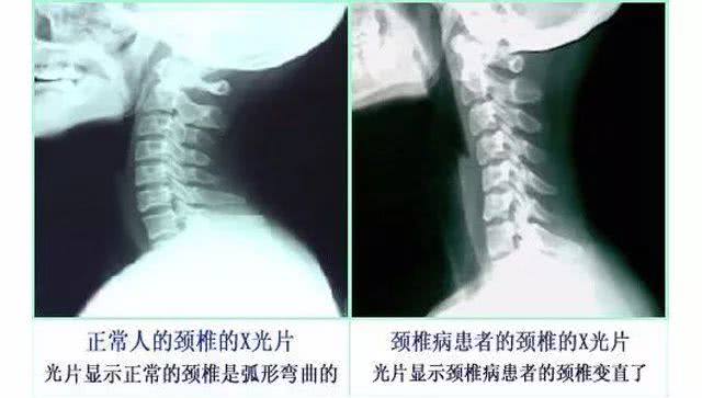 颈椎病引起头疼头晕中成药,颈椎病引起头晕恶心怎么办