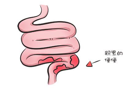 婴儿便秘4天了怎么办,4岁宝宝严重便秘一招通便