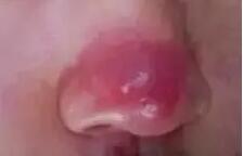 鼻子红红的酒糟鼻怎么护肤,怎么判断自己的鼻子是不是酒糟鼻