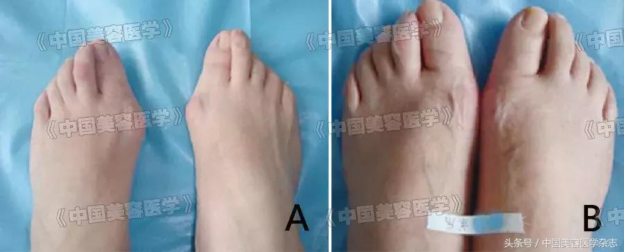 大脚拇指外翻矫正治疗,大脚骨拇指外翻真的能矫正好吗