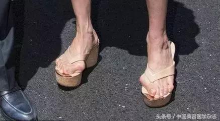 大脚拇指外翻矫正治疗,大脚骨拇指外翻真的能矫正好吗