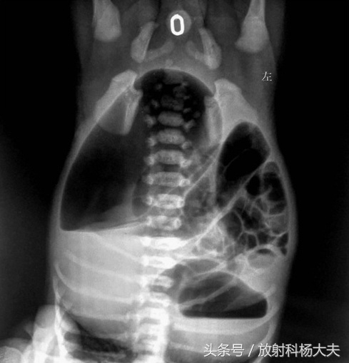 宝宝没有眼睑畸形,孩子没有其他症状只是翻白眼