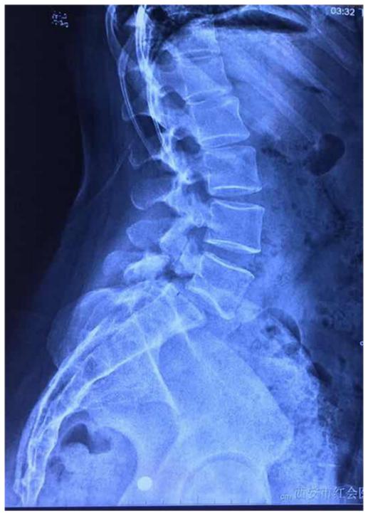 腰椎滑脱还有峡部裂怎么治疗,峡部裂型腰椎滑脱进展