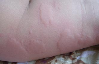 宝宝身上起丘疹麻疹怎么办,宝宝身上起荨麻疹一样的风团