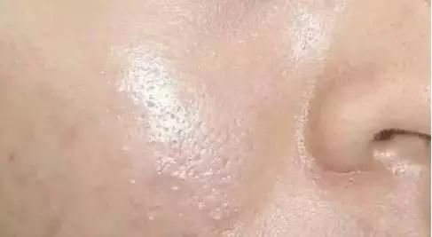 疮疤怎样彻底消除,很严重的干疮用什么药最好