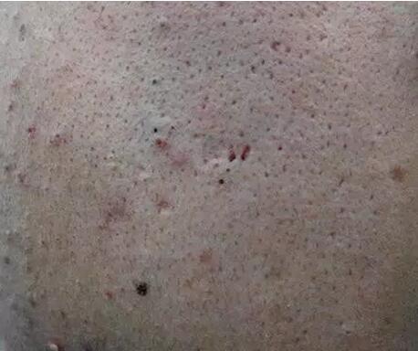 油性皮肤毛孔粗大怎么改善最有效,毛孔出油粗大如何改善小技巧