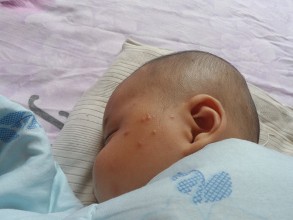 孩子妈妈一脸痘怎么避免孩子长痘,一岁半宝宝长青春痘