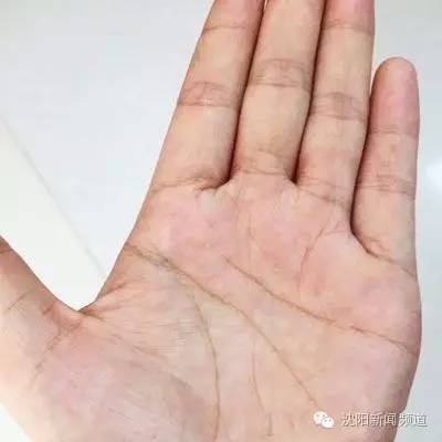 如果你身上有很多包要怎么办,如果你身上有个痣是好事还是坏事