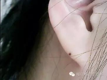 看耳朵识女人,看耳朵能看出肾的情况吗