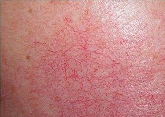 遗传性红血丝根治的方法,遗传性的红血丝可以治好吗