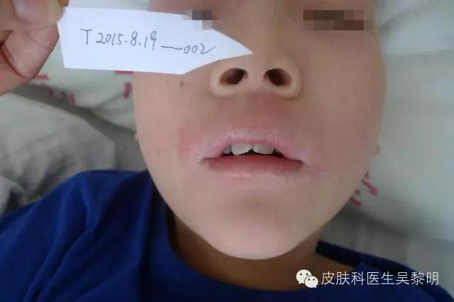 透明质酸护肤品功效,透明质酸是修复皮肤敏感成分