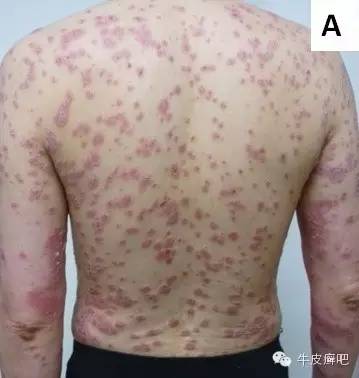 皮肤科专家谈论银屑病生物制剂,中国治疗银屑病新药生物制剂