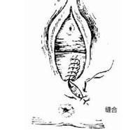 孕妇顺产侧切一般多少天恢复,顺产侧切和撕裂哪个好恢复