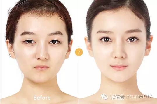 脸上部分凹陷,年龄增长脸颊凹陷