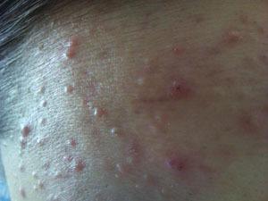 额头下巴长痘痘的原因和解决方法,额头长痘痘的原因和解决方法