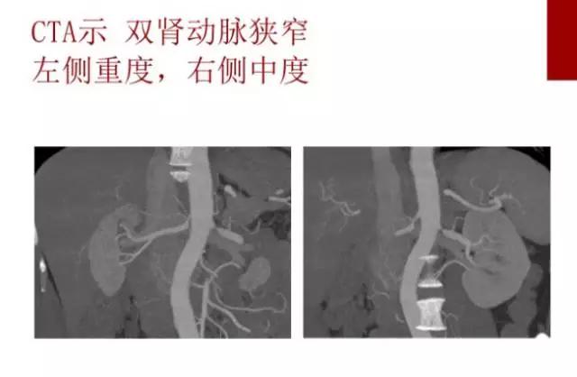 28岁出现高血压，恐怕没这么简单！