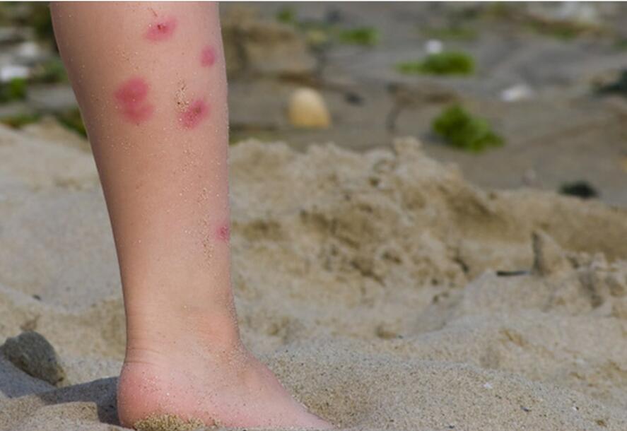 当妈的因为不知道这个,儿子被蚊子叮咬后……