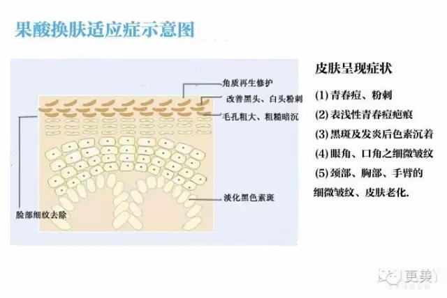 果酸换肤是整容吗,果酸换肤不做后会复发吗