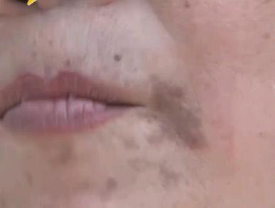 常见黑斑产生的6大因素，了解才能更好解决