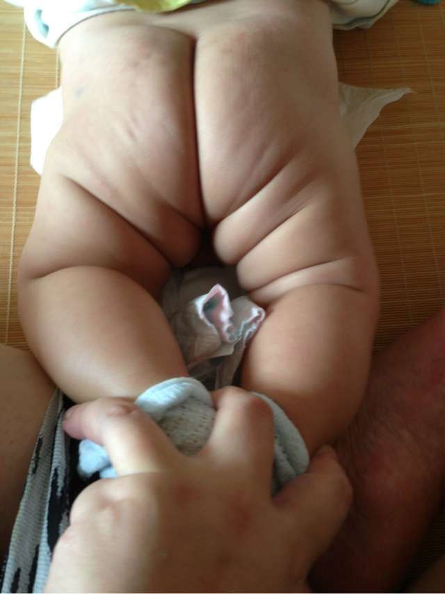 婴儿腿沟不对称需要治疗吗,婴儿腿沟不对称