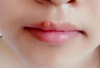 嘴唇上火长泡,变成黑印怎么办?学会自己去火,去黑印