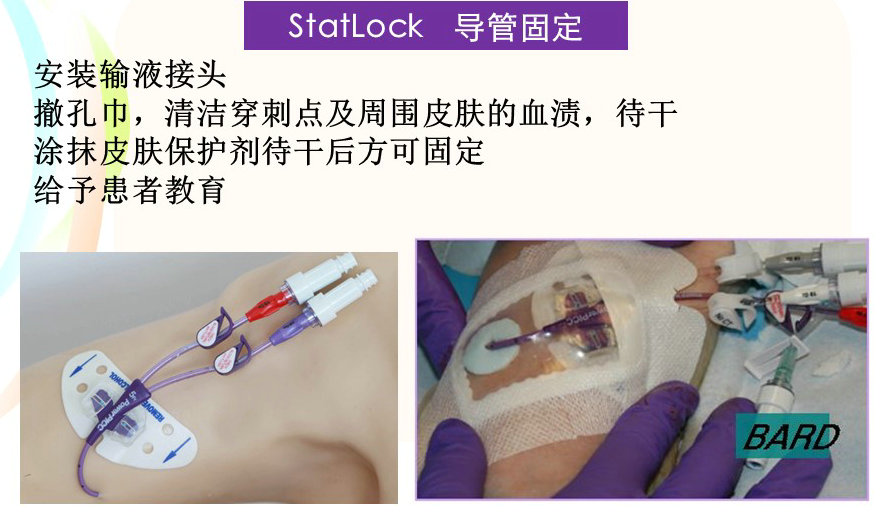 超声引导下改良塞丁格技术解剖图,超声引导下pdca置管