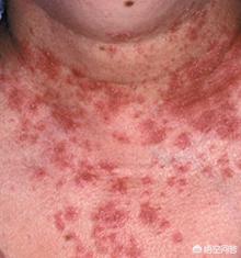 靶向治疗需要几天恢复,服用靶向药几个小时后出现副反应