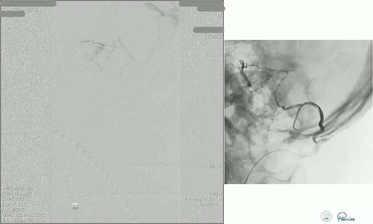 球囊辅助Onyx栓塞治疗硬脑膜动静脉瘘（DAVF）