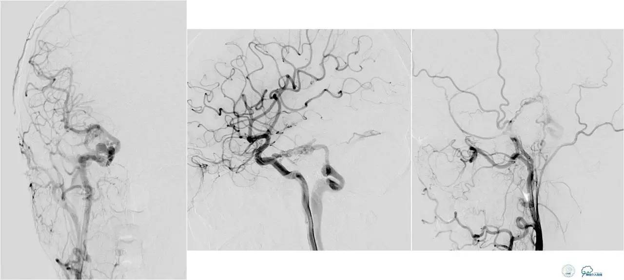 球囊辅助Onyx栓塞治疗硬脑膜动静脉瘘（DAVF）