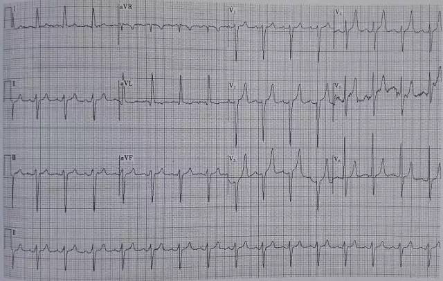 “有声播报”第三期│T波高尖，可能会是哪些疾病？
