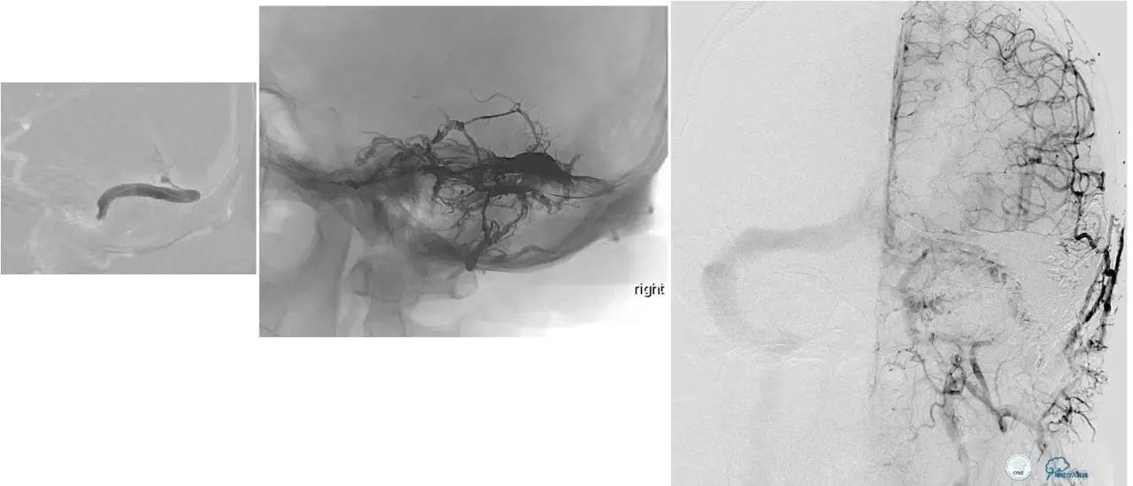 球囊辅助Onyx栓塞治疗硬脑膜动静脉瘘（DAVF）