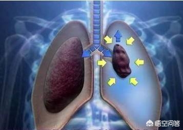 肺内常有气泡破裂的感觉并有疼痛感是怎么回事，可能是气胸前奏