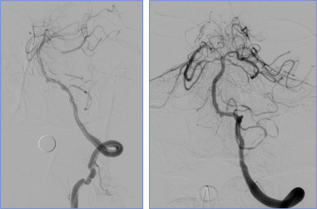 缺血性脑卒中术后管理,急性缺血性脑卒中血管内治疗